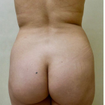 Brazilian Butt Lift Before & After Patient #1225