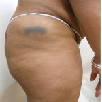Brazilian Butt Lift Before & After Patient #1222