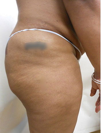 Brazilian Butt Lift Before & After Patient #1222