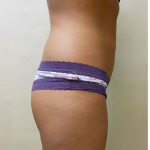 Brazilian Butt Lift Before & After Patient #1224