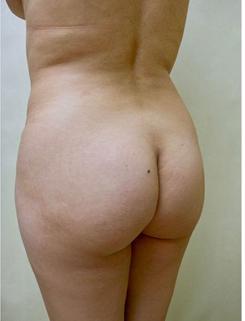 Brazilian Butt Lift Before & After Patient #1225