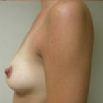 Breast Augmentation Before & After Patient #368