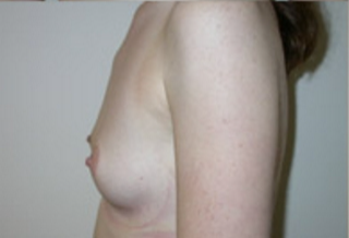 Breast Augmentation Before & After Patient #421