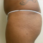 Brazilian Butt Lift Before & After Patient #1133