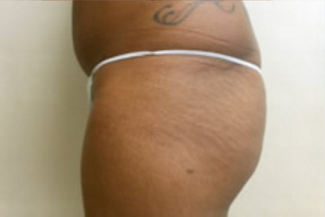 Brazilian Butt Lift Before & After Patient #1133