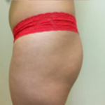 Brazilian Butt Lift Before & After Patient #1136