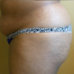Brazilian Butt Lift Before & After Patient #1139