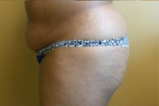 Brazilian Butt Lift Before & After Patient #1139