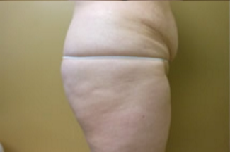 Brazilian Butt Lift Before & After Patient #1177