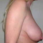 Breast Lift Before & After Patient #426