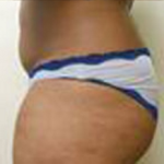 Brazilian Butt Lift Before & After Patient #1179