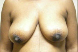 Breast Lift Before & After Patient #429