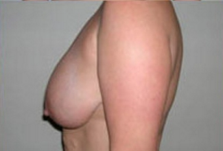 Breast Lift Before & After Patient #430