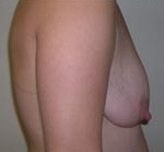 Breast Lift With Augmentation Before & After Patient #460