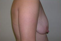 Breast Lift With Augmentation Before & After Patient #460