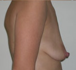 Breast Lift With Augmentation Before & After Patient #462