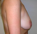 Breast Lift With Augmentation Before & After Patient #463