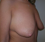 Breast Lift With Augmentation Before & After Patient #464
