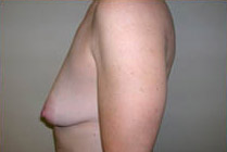 Breast Lift With Augmentation Before & After Patient #465