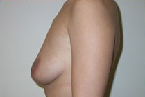 Breast Lift With Augmentation Before & After Patient #466