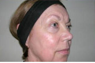 Face Lift Before & After Patient #629