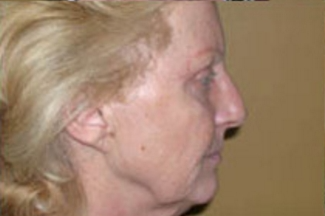 Face Lift Before & After Patient #631