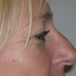 Rhinoplasty Before & After Patient #667