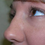 Rhinoplasty Before & After Patient #669
