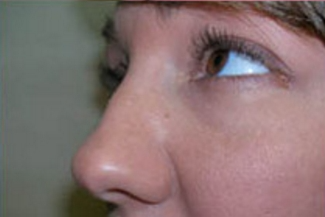 Rhinoplasty Before & After Patient #669