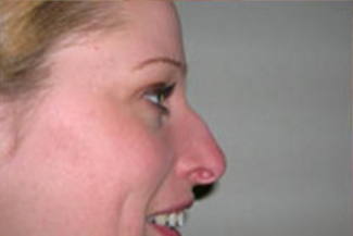 Rhinoplasty Before & After Patient #670