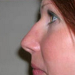 Rhinoplasty Before & After Patient #671