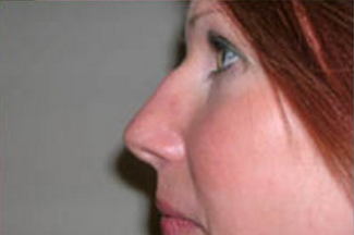 Rhinoplasty Before & After Patient #671