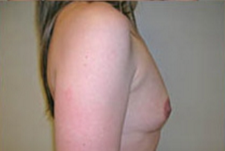 Breast Augmentation Before & After Patient #371