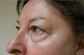 Blepharoplasty Before & After Patient #702