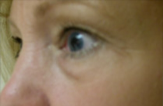 Blepharoplasty Before & After Patient #736