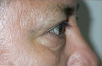Blepharoplasty Before & After Patient #737