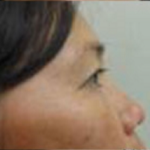 Blepharoplasty Before & After Patient #738