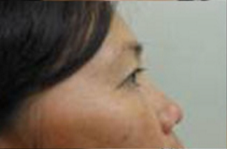 Blepharoplasty Before & After Patient #738