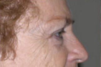 Browlift Before & After Patient #770