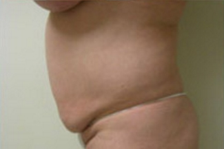 Abdominoplasty Before & After Patient #785