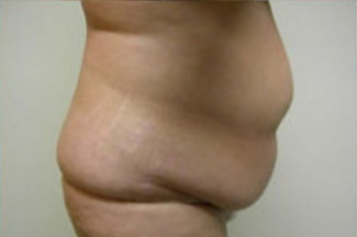 Abdominoplasty Before & After Patient #786
