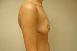 Breast Augmentation Before & After Patient #373