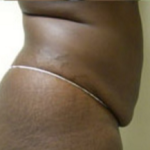 Abdominoplasty Before & After Patient #787
