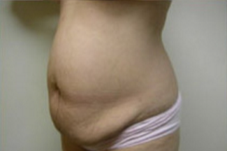 Abdominoplasty Before & After Patient #788