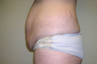 Abdominoplasty Before & After Patient #844