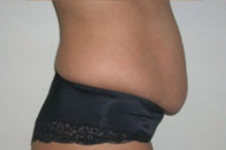 Abdominoplasty Before & After Patient #847
