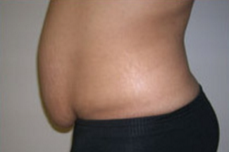 Abdominoplasty Before & After Patient #848