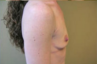 Breast Augmentation Before & After Patient #374