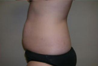 Abdominoplasty Before & After Patient #849