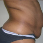 Abdominoplasty Before & After Patient #850